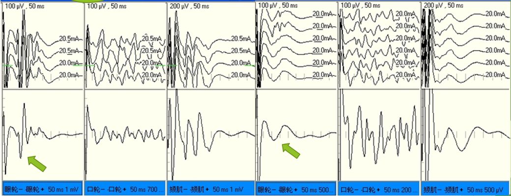 术中通过针状电极监测眼轮匝肌,口轮匝肌以及颏肌肌电活动