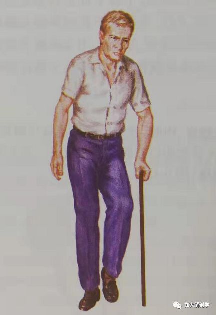 步态分析——临床常见异常步态及常用矫治训练方法_患者