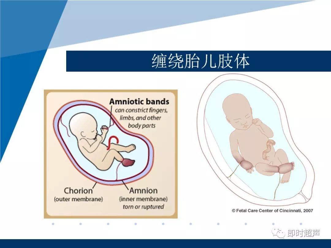 羊膜带综合征amnioticbandsyndrome
