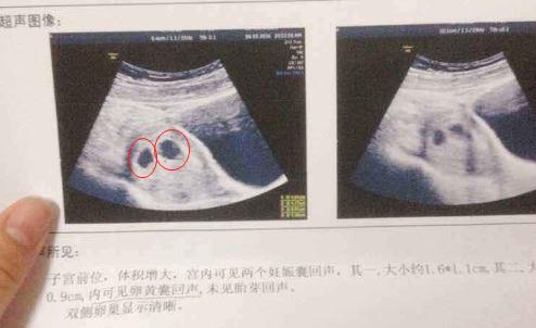 怀男宝的孕囊形状图片图片