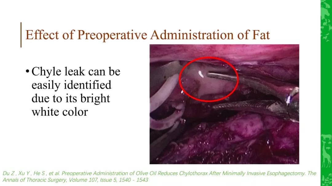 「journal club」术前进食脂肪可降低食管术后乳糜胸发生率