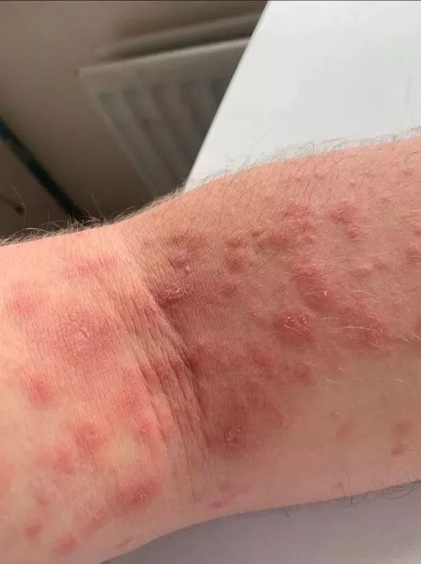 夏季出游注意英国乡村这种大猪草长得可爱但不小心碰到就惨了