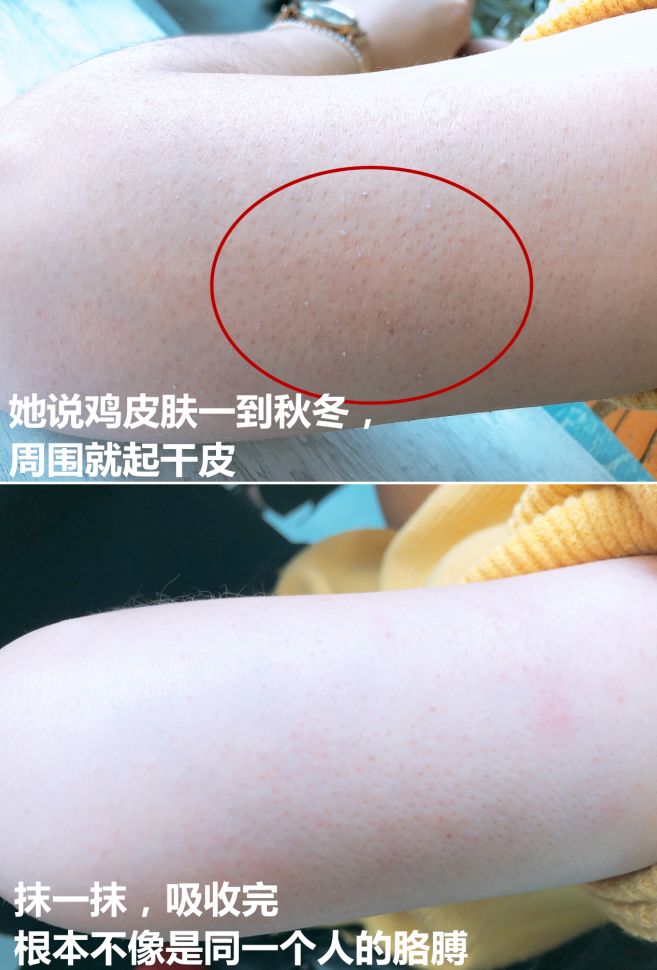 鸡皮肤跟皮肤缺水有关系吗(鸡皮肤跟皮肤缺水有关系吗怎么治疗)