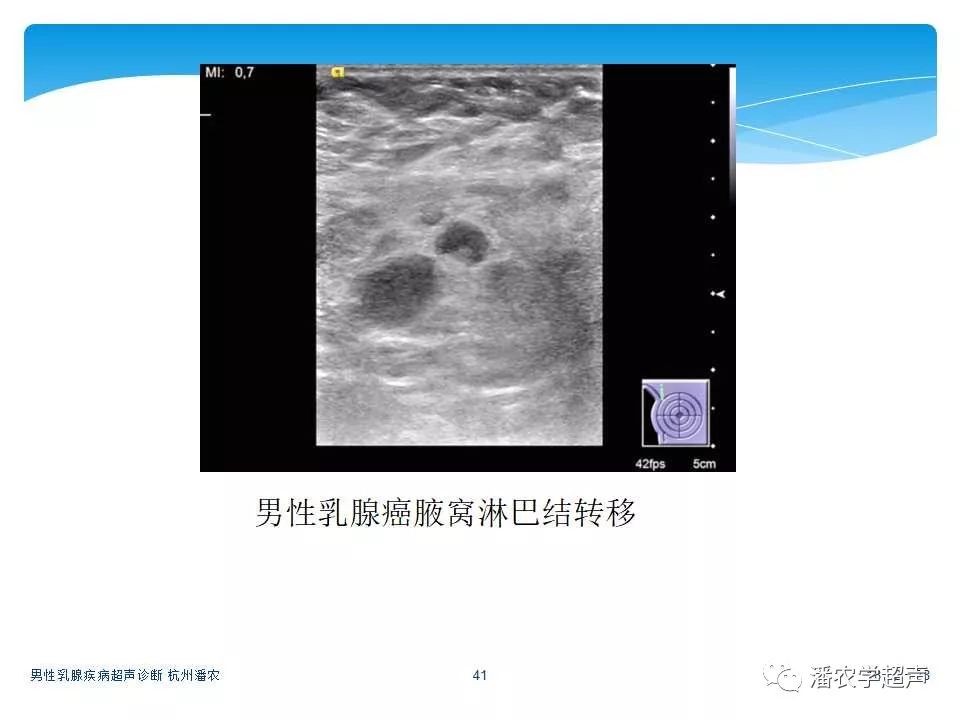 【歸納】男性乳腺疾病超聲診斷