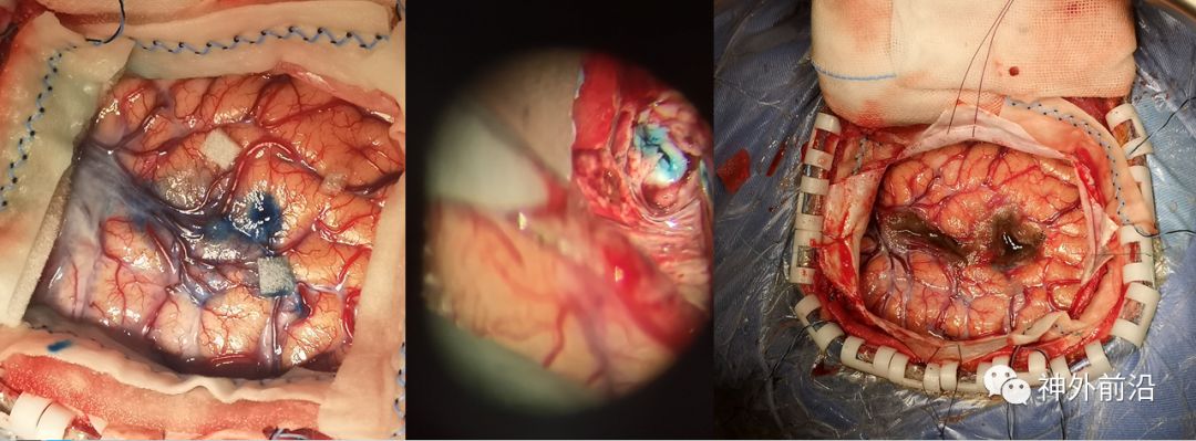 大脑皮层;中图显示术中显微镜下深部病变组织蓝染