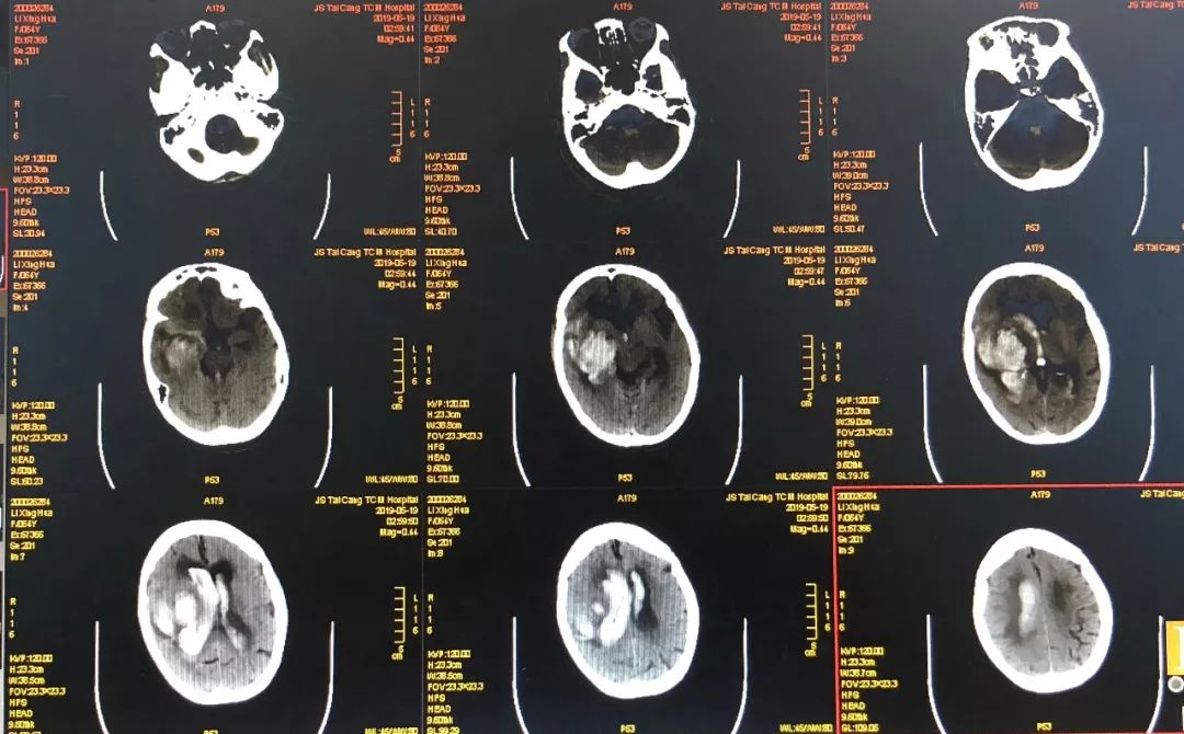 患者术前ct检查虽然现在意识状况还好,但脑室的铸型死亡率极高,还有
