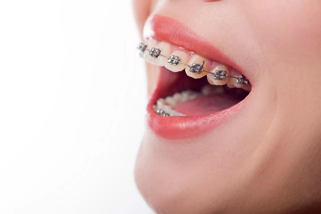 4种常见类型的牙套教你如何选择适合自己的矫治器