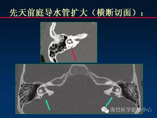 前庭导水管图片