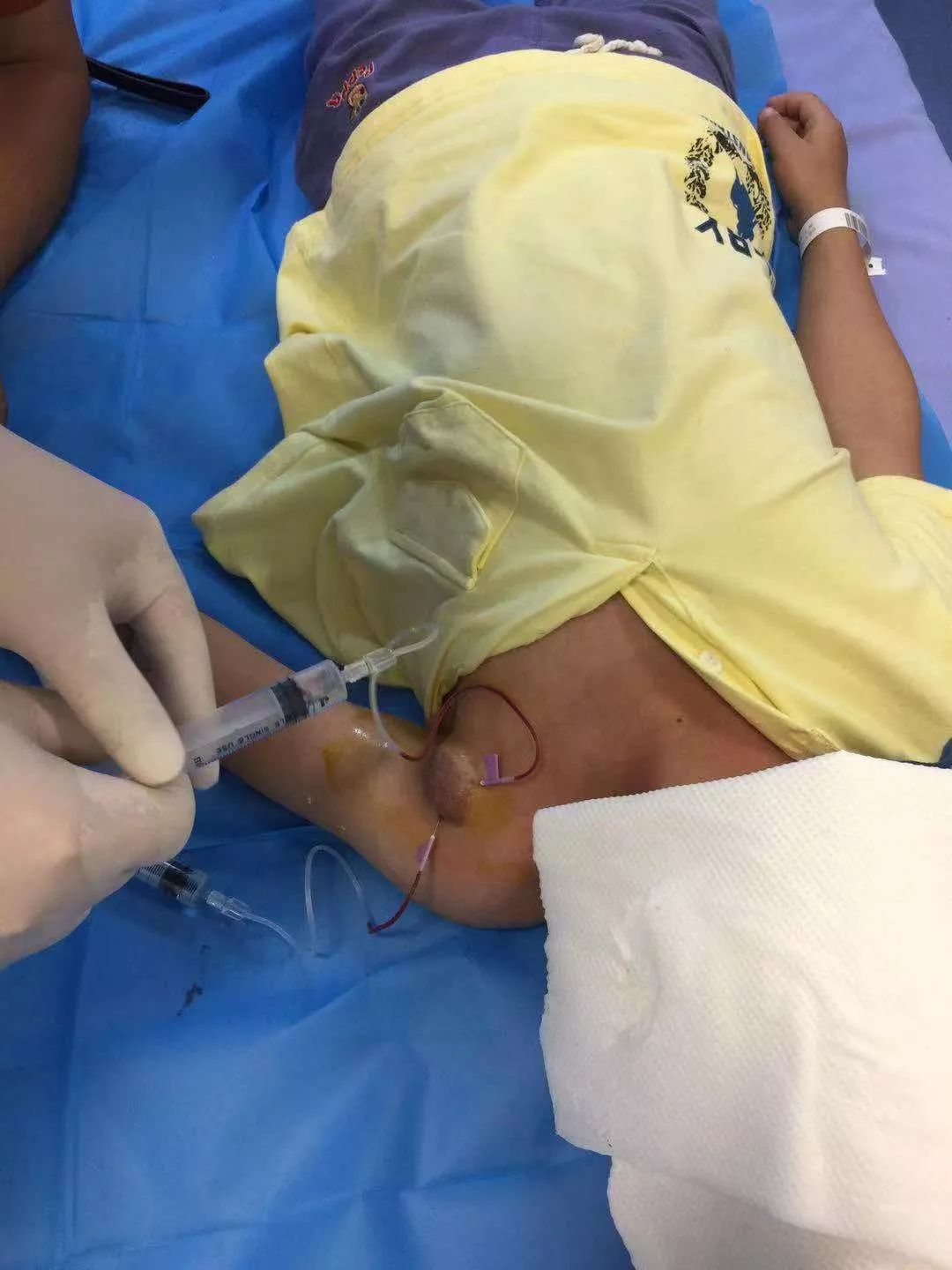 慕名前来的下肢静脉曲张患者请求秦教授诊治>>>广东广州   粤港澳大湾