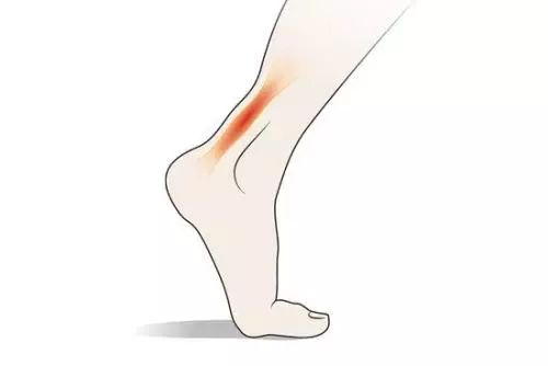 跟腱炎临床表现典型症状:足跟部上方的,内部的疼痛,酸痛,压痛,僵硬