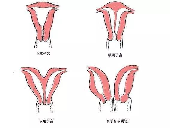 双子宫双宫颈外观图片图片