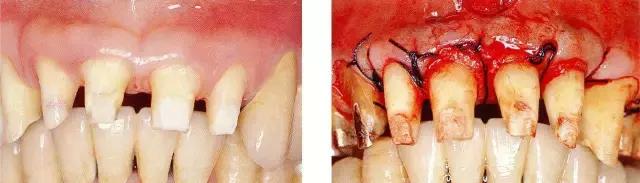 进行牙周袋去除,取得biologic width,牙周组织长期得以安定状态的病例