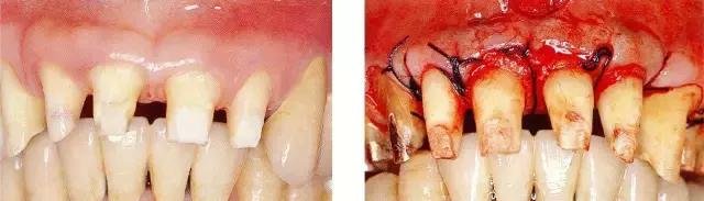 深牙周袋的治疗技术图解