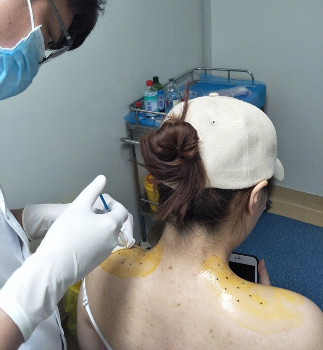 这些黑色的小点点就是注射部位两个肩膀加起来差不多要扎二三十针吧