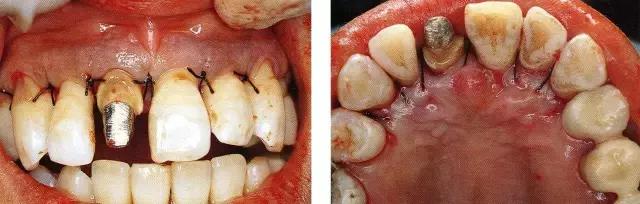 有牙周炎的牙周袋图片图片