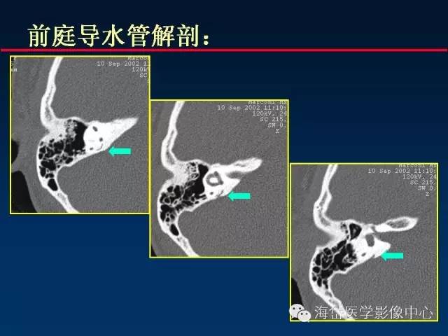 耳蜗导水管图片