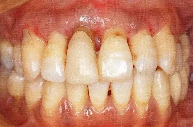 因牙周炎而形成的深牙周袋,有各种各样的治疗方法