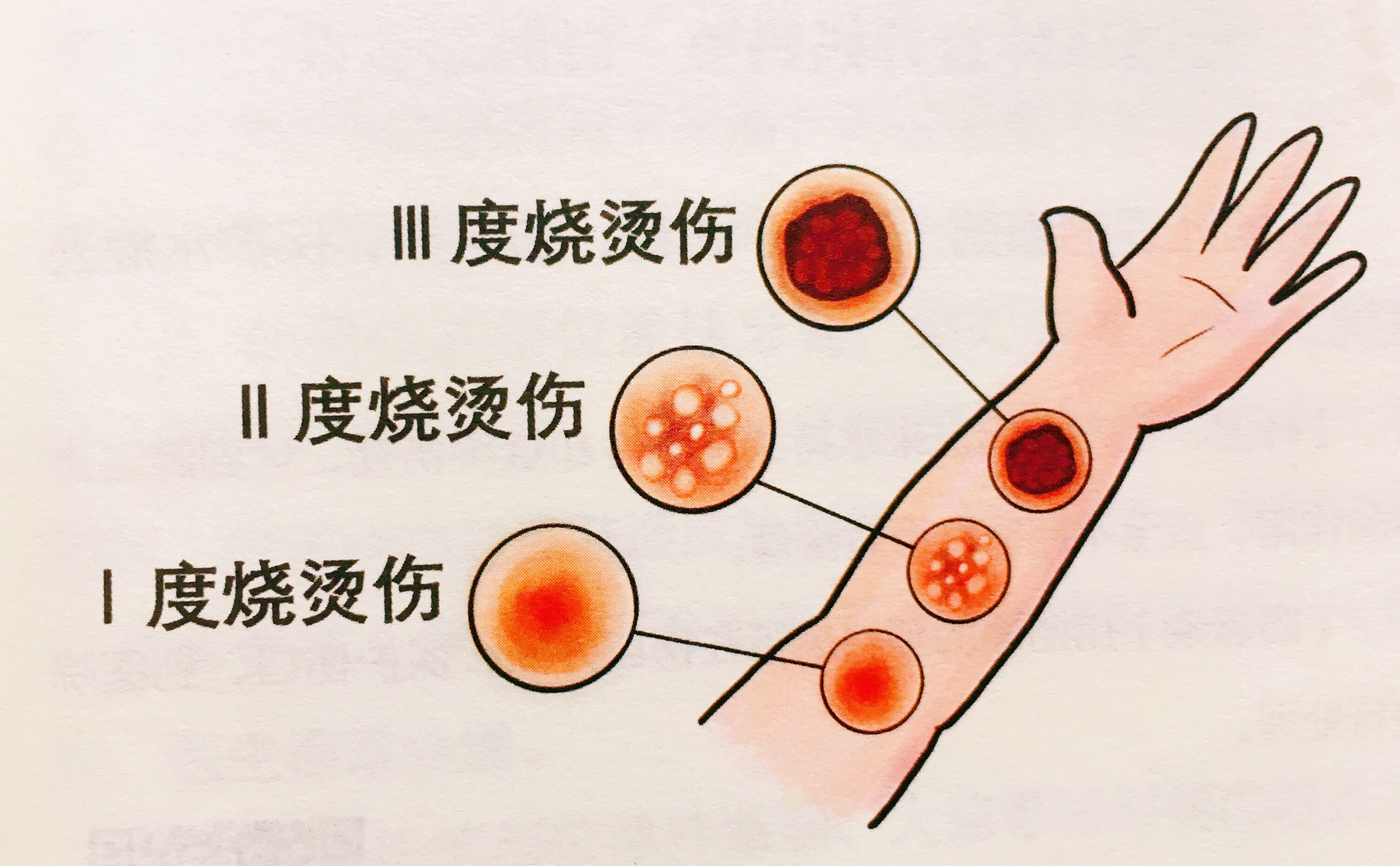 烧伤照片 卡通图片图片