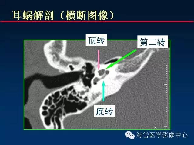 颅底重要ct解剖及其临床意义前庭导水管与耳蜗