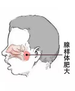 病例:5歲寶寶,檢查腺樣體肥大4度,治療一段時間4月檢查仍然一樣,醫生