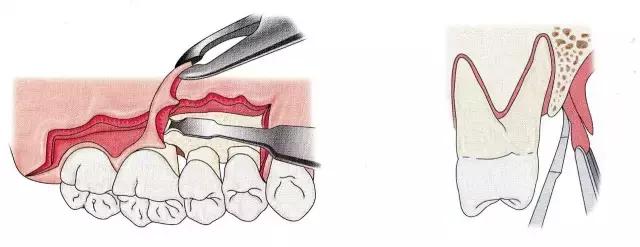 深牙周袋的治疗技术图解