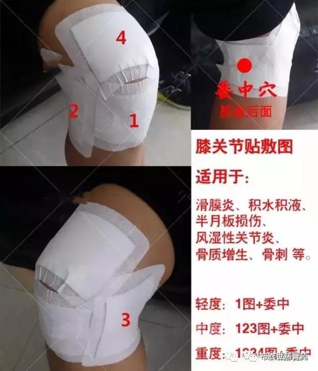 【滑膜炎知识】初期会疼,轻微疼,走路上下楼都疼,没有积水积液;中期有