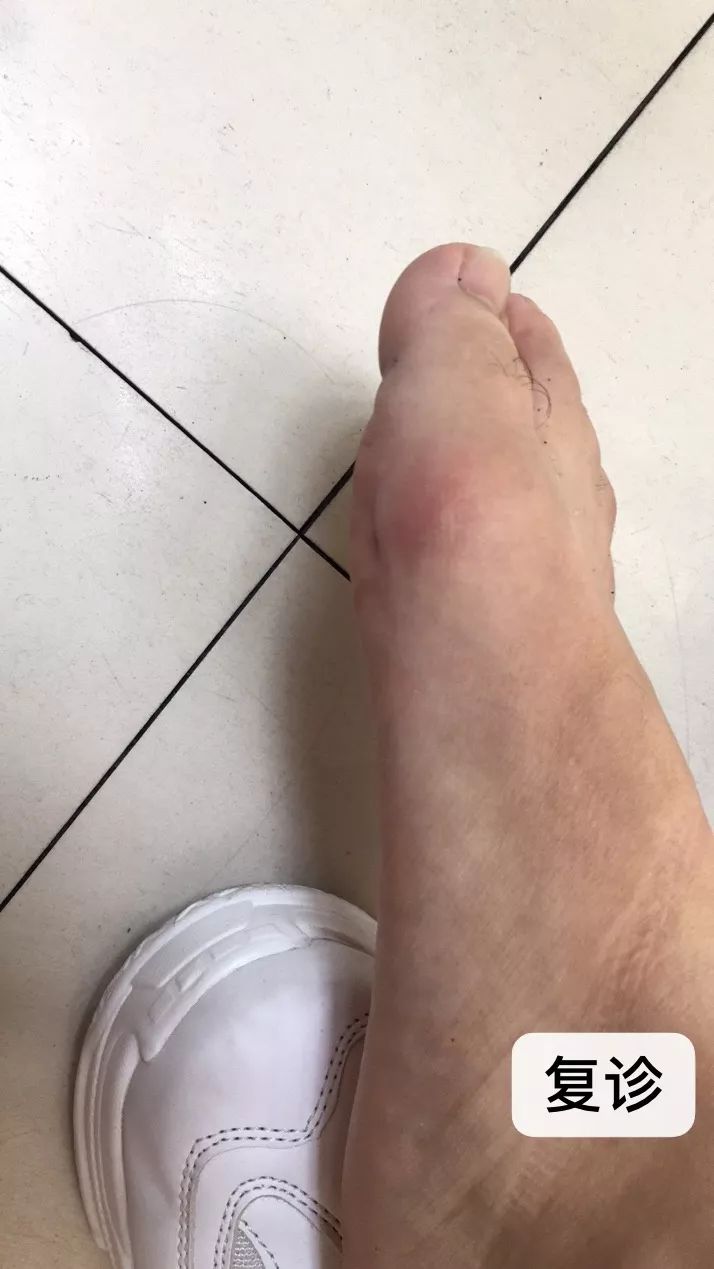 精品班交流韩其茂痛风性关节炎案