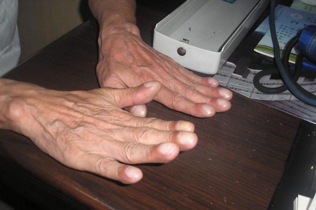 肺癌早期症状居然跟感冒差不多身体出现这9种变化要当心了