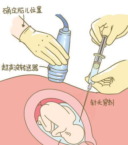 子宫壁,进入羊水腔,抽取一些羊水的过程叫作"羊水穿刺"