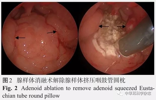 腺样体手术过程图图片