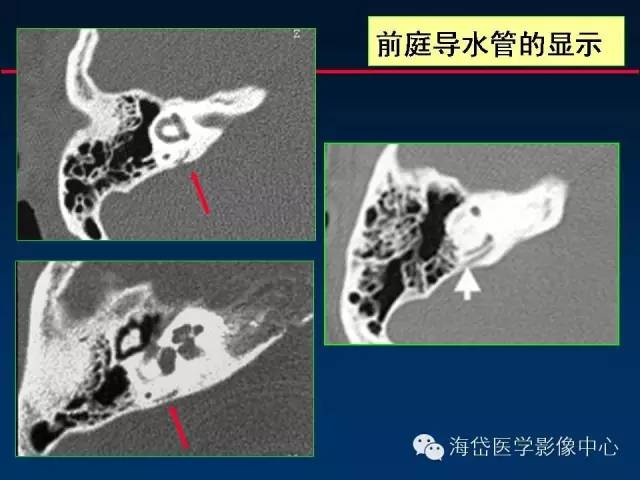 颅底重要ct解剖及其临床意义前庭导水管与耳蜗