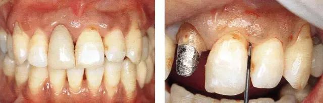 通过这个病例,可清楚由于上颚门牙的牙冠较长,牙周袋较深,如果进行