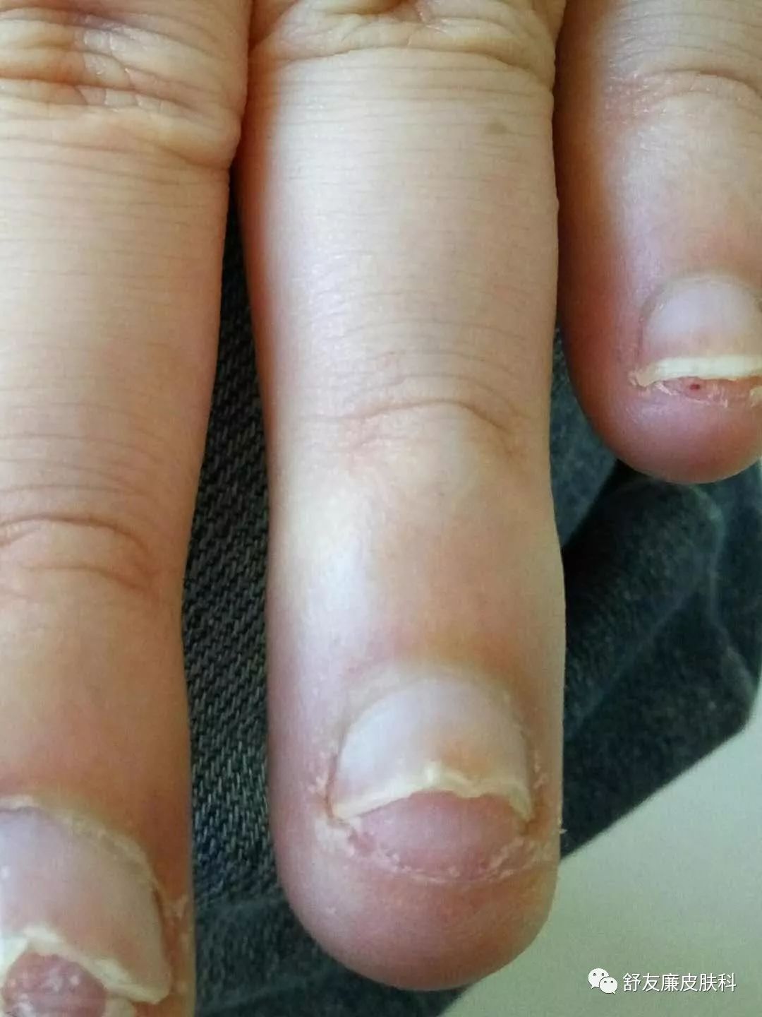 甲床受损长出的指甲图图片