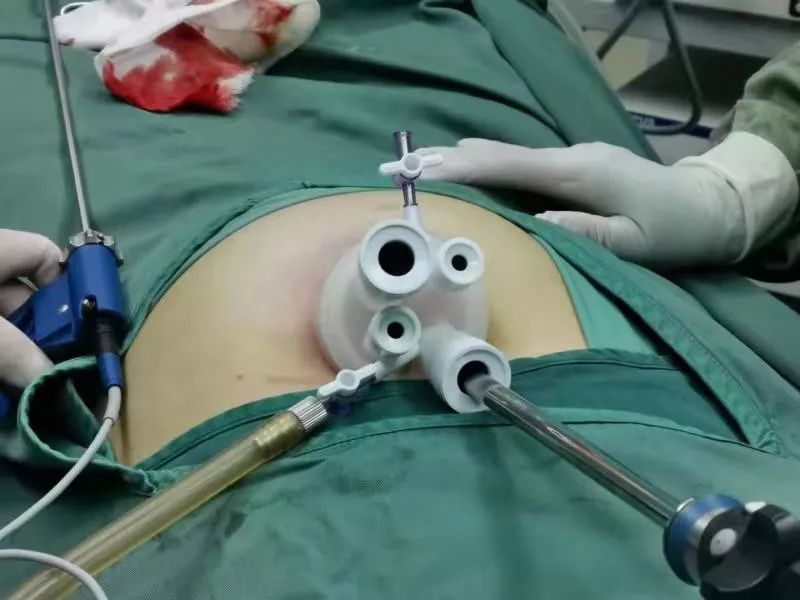 完美的技术西青医院妇科完成首例单孔腹腔镜下盆腔巨大肿物剥除