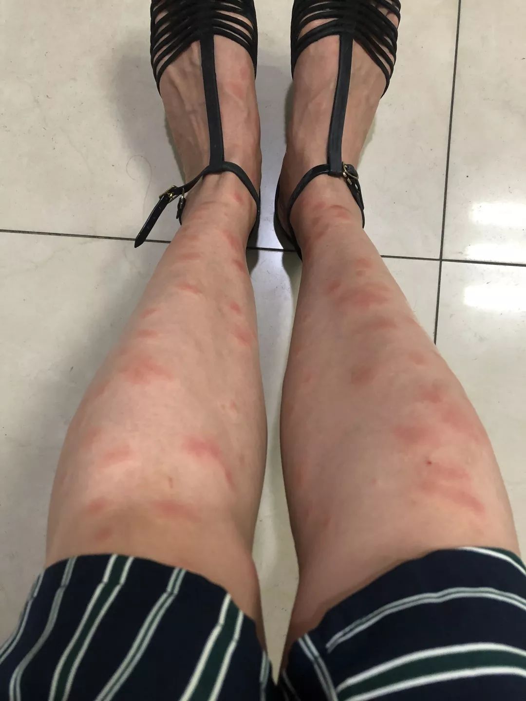 被咬后奇痒无比外出游玩当心这种神秘小黑虫