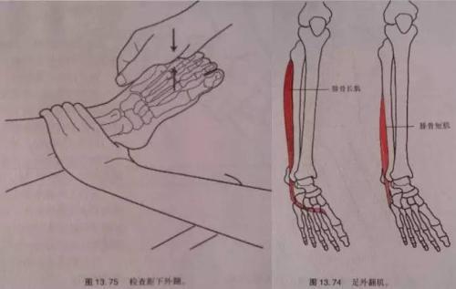 腓骨肌腱脱位示意图图片