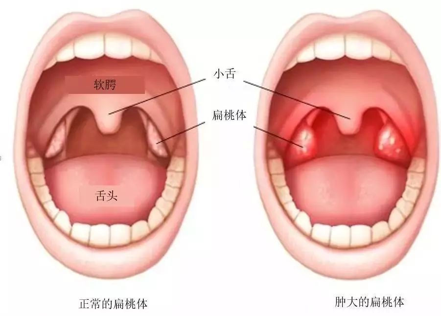 鼻咽部腺图片