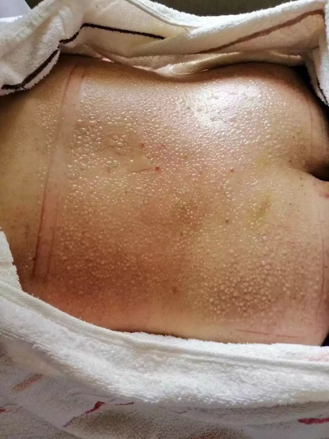 温通经络温肾壮阳,元气充足三伏天艾灸的好处艾灸疗法能减肥瘦身,防病