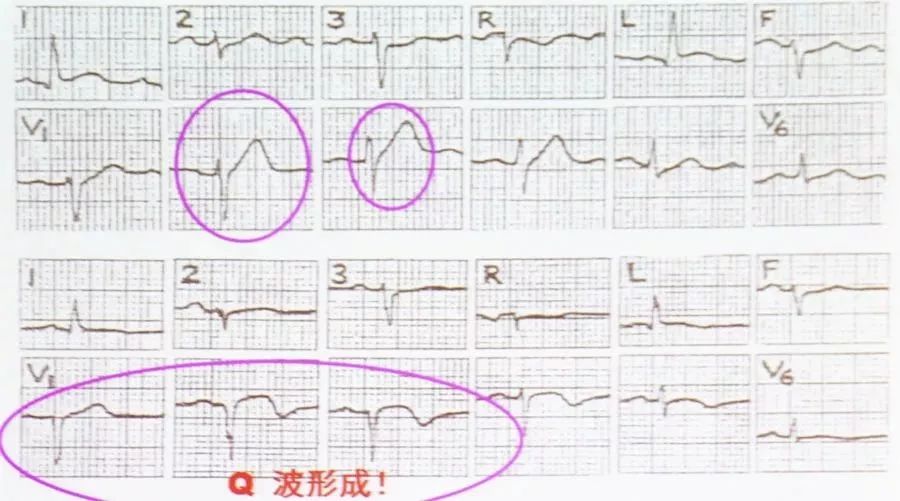 中危时,表现为t波倒置