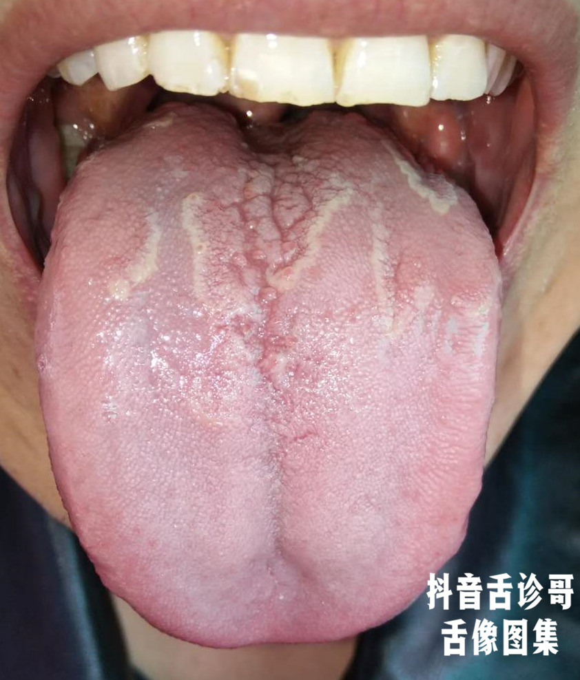 舌诊哥舌诊知健康教你学会看舌象系列五十七