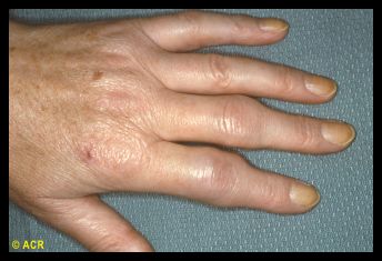 风湿关节痛是类风湿关节炎