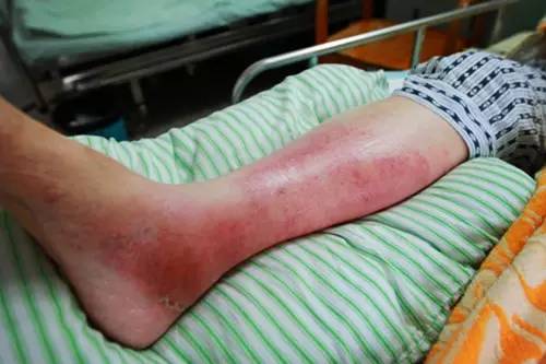 未来13天10天全有雨长春人警惕男子蹚水染上丹毒严重可致命