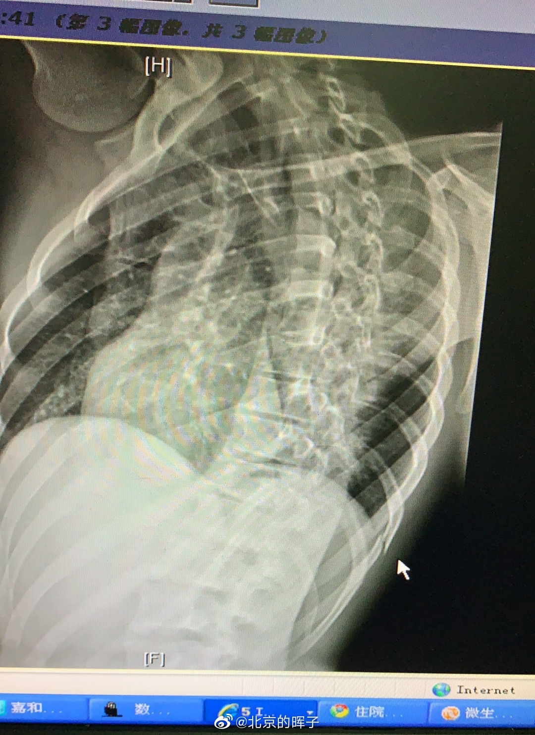 国安折损大将比埃拉肋骨骨折恢复期或在12周左右