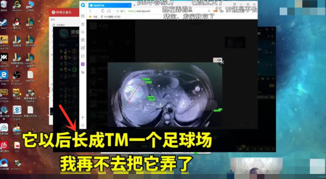 pdd直播辟谣并没有身患12颗肿瘤自己身体好得很