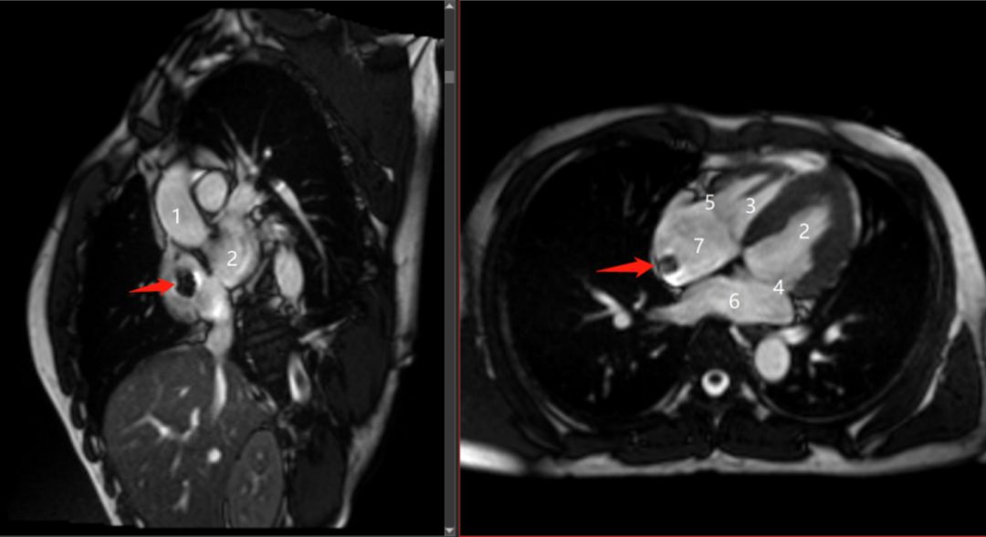 心脏磁共振在心脏占位中的优势与价值右房黏液瘤案例分享
