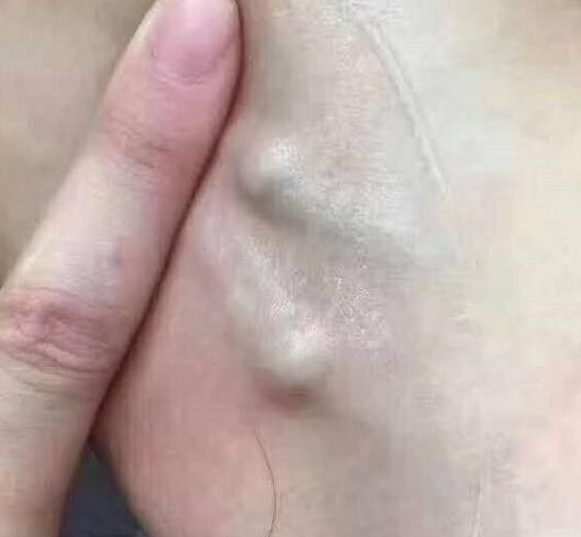 颈部淋巴结负责处理头部的毒素,推通这里可以预防和改善头部的很多