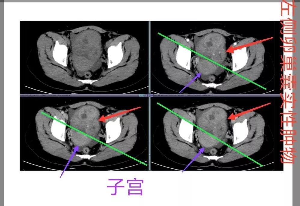 这个不是ct的长处,不过不要紧,如果超声发现子宫或宫颈异常,可以刮宫