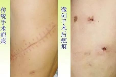【医疗广角】现在可以这样解决自发性气胸!_手术