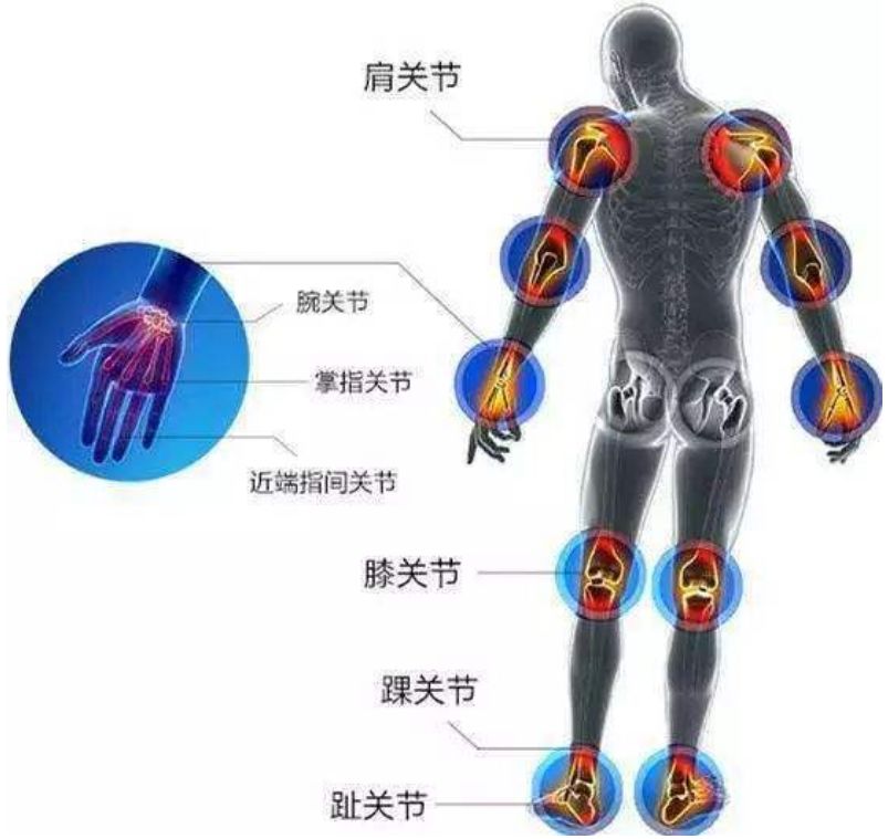 类风湿性关节炎机制图片