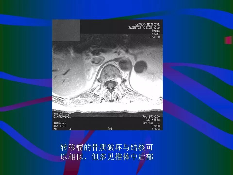 脊柱结核的ct及mri诊断影像天地